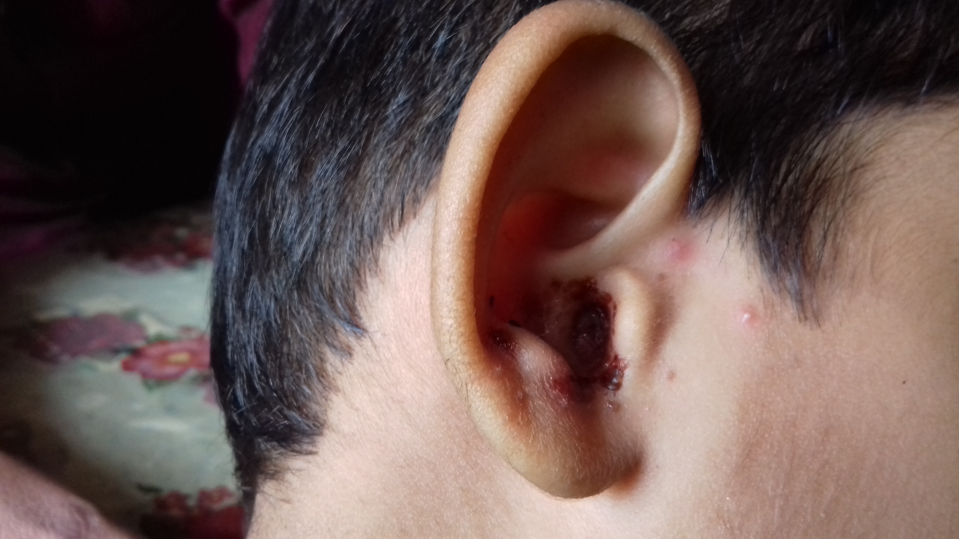 External Otitis